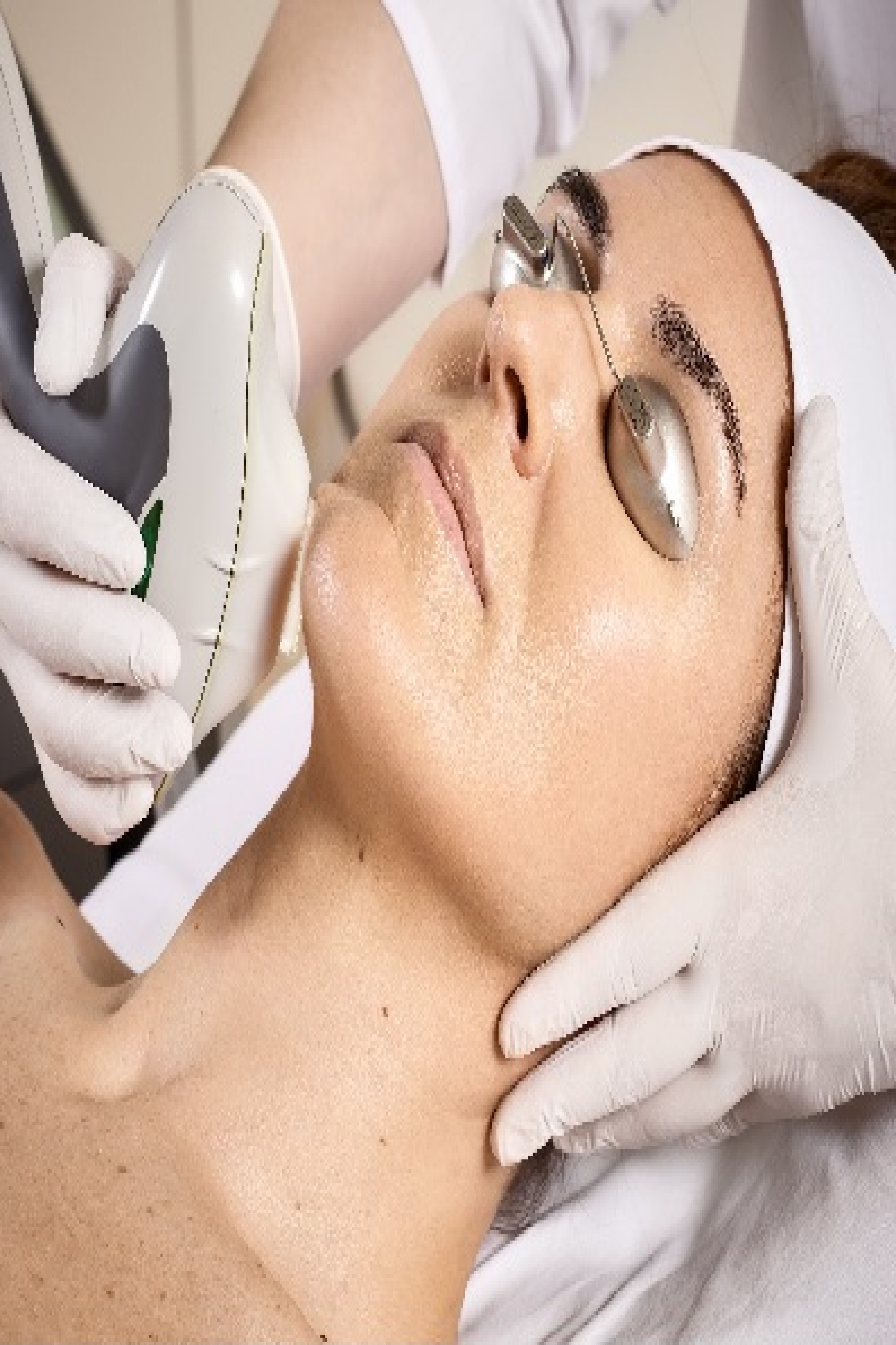 Tratamiento de Acné IPL